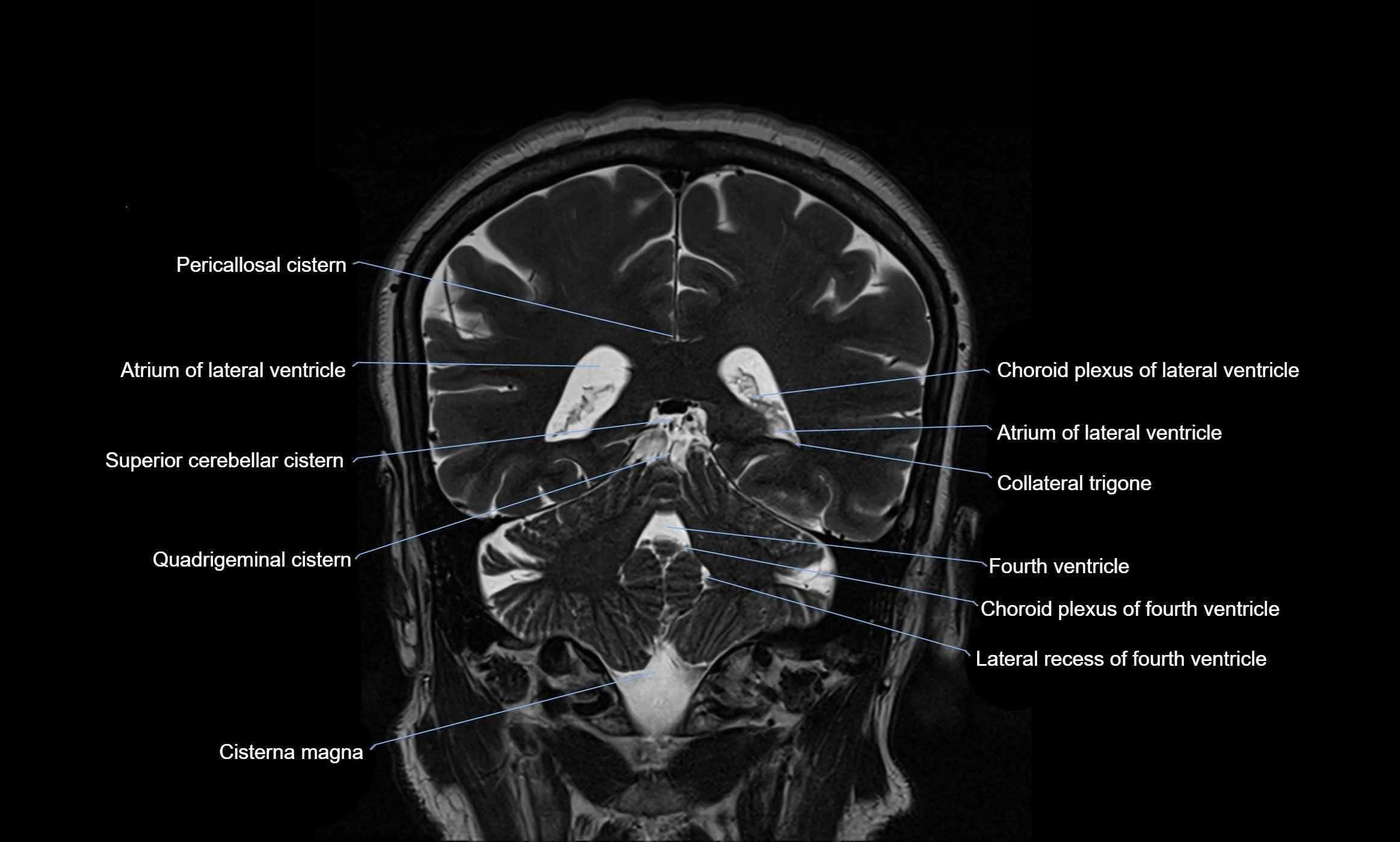 Brain cisterns  and ventricles coronal anatomy 3T MRI image-img-00001-00041.webp